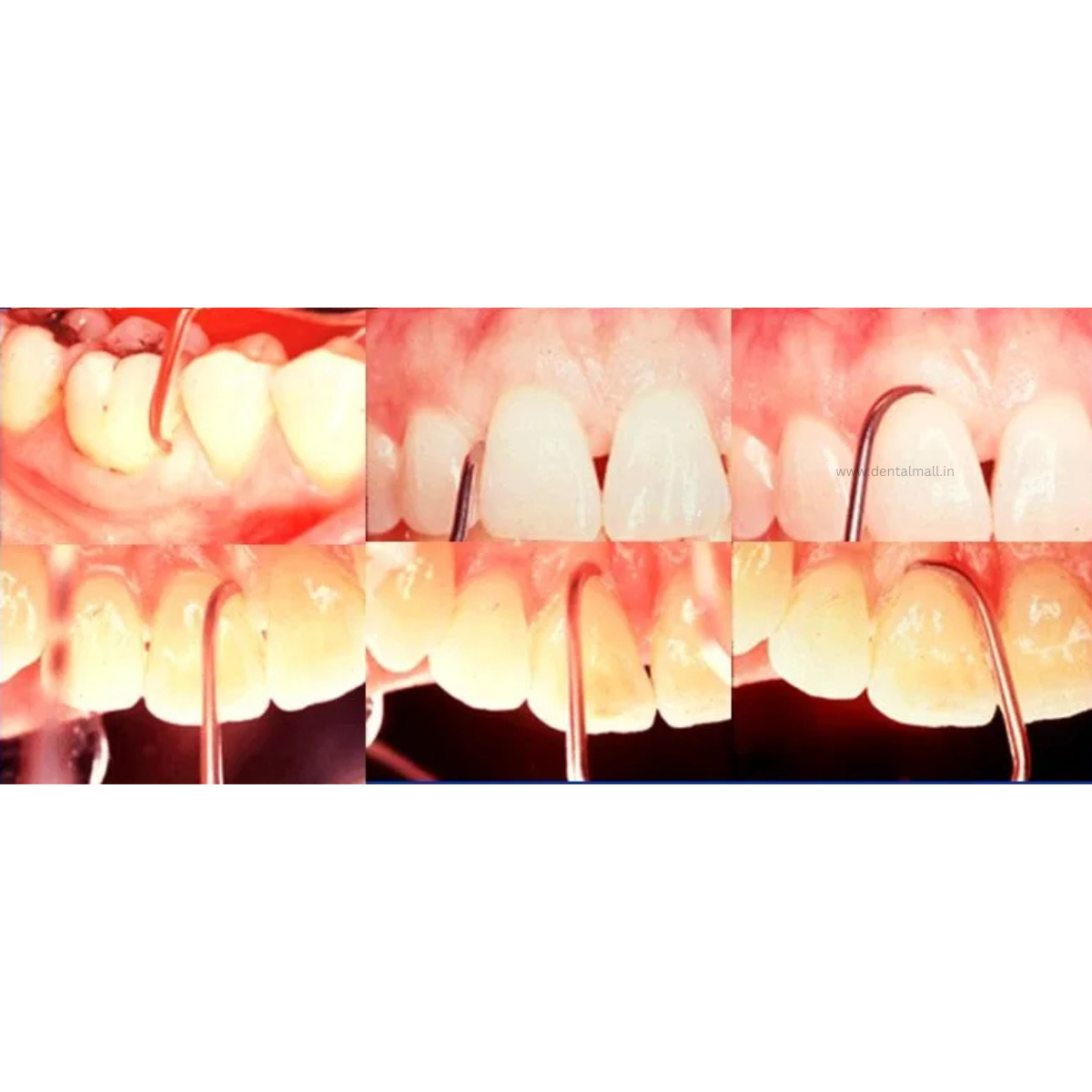 Gracey Curette Set Of 7 Pcs Ergonomic Premium Sandblasting Handle with Cross Serration Handle Pattern #GCSK7HH