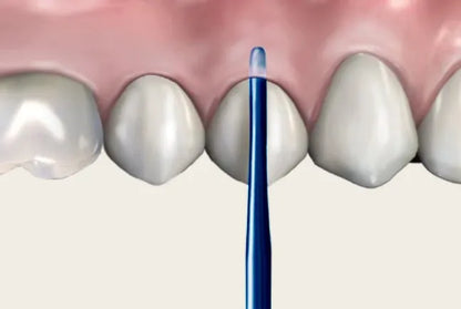 Midelux & Medimpla Rapid Loosening Tooth System