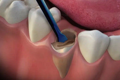 Midelux & Medimpla Rapid Loosening Tooth System