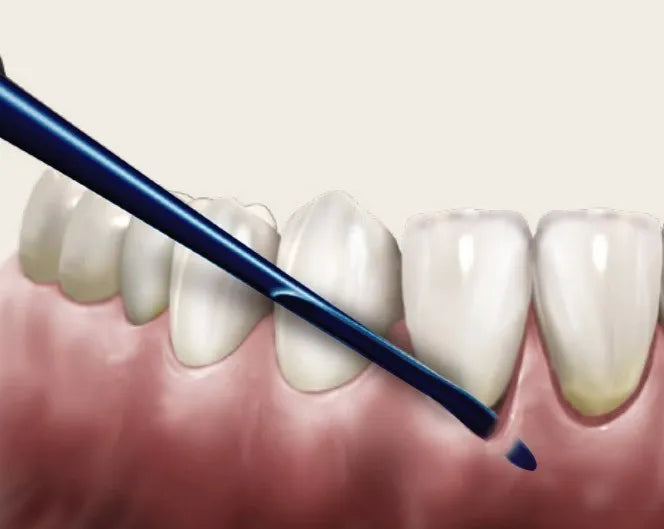 Midelux & Medimpla Rapid Loosening Tooth System